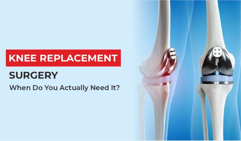 Knee Replacement Surgery: When Do You Actually Need It?